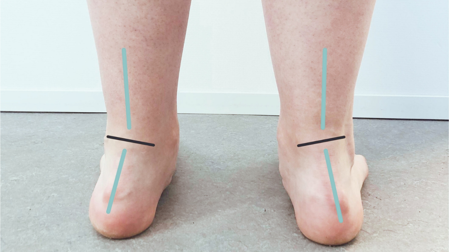 Insoles for overpronation Get custommade 3Dprinted insoles